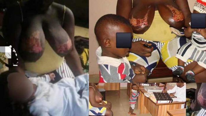 Ghanaian Man pours hot water on his breastfeeding Nigerian wife