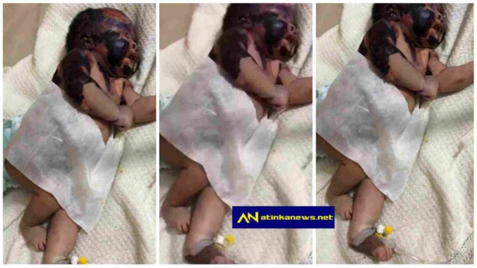 newborn baby suffers burns