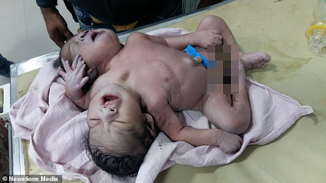 Baby born with two heads
