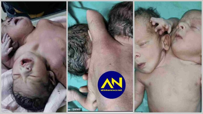 Baby born with two heads, three arms and two hearts